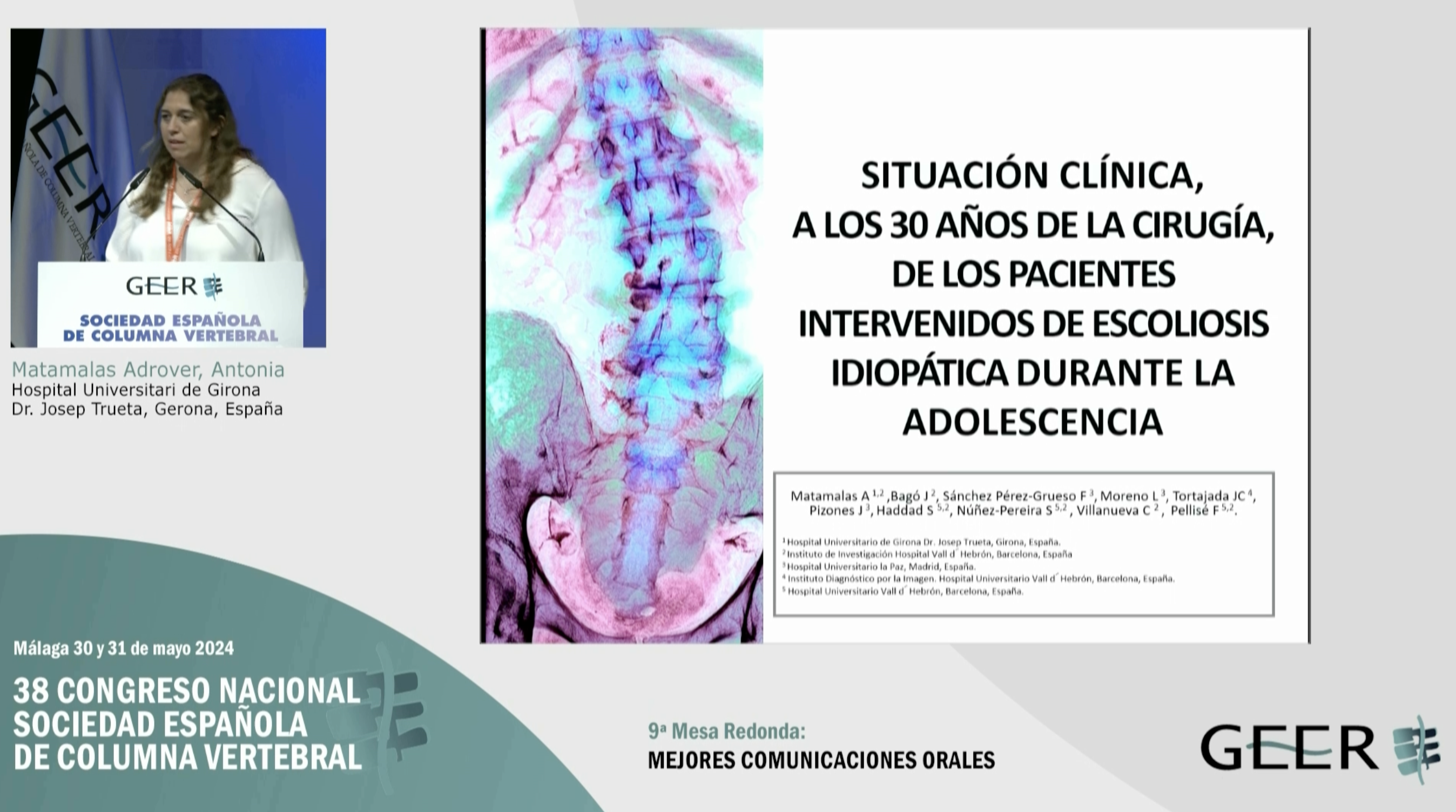 C.O.40. Situación clínica, a los 30 años de la cirugía, de los pacientes intervenidos de escoliosis idiopática durante la adolescencia